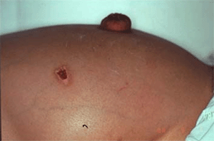 腹水が貯留した腹部