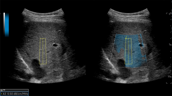 NAFLD_4.png