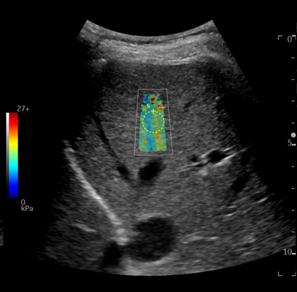 NAFLD_5-1.png