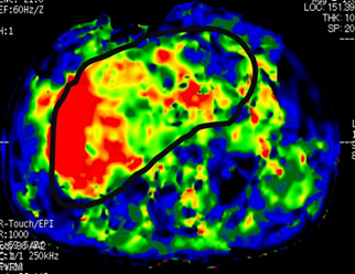 NAFLD_5-2.png